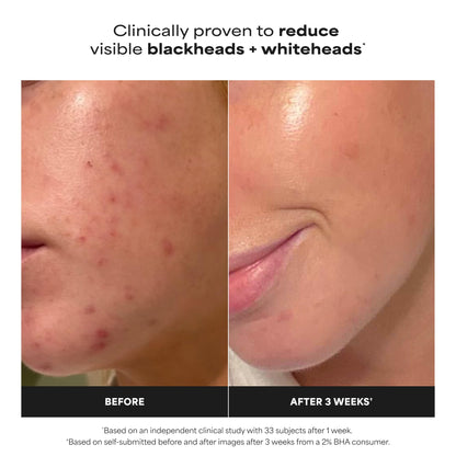 Paula's Choice SKIN PERFECTING 2% BHA Liquid Salicylic Acid Exfoliant, Daily Facial Exfoliator for Enlarged Pores, Wrinkles & Fine Lines, Fragrance-Free, Travel Size - 30 ml 🍁 All In One Marketplace Canada