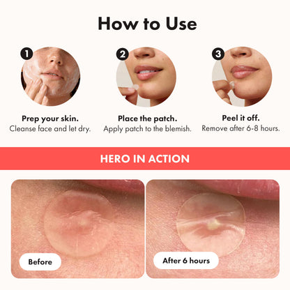 Hero Cosmetics Mighty Patch Original – Hydrocolloid Patch for Pimples, Overnight Acne Blemish & Zit Stickers for Sensitive Skin, (72 Count) 🍁 All In One Marketplace Canada